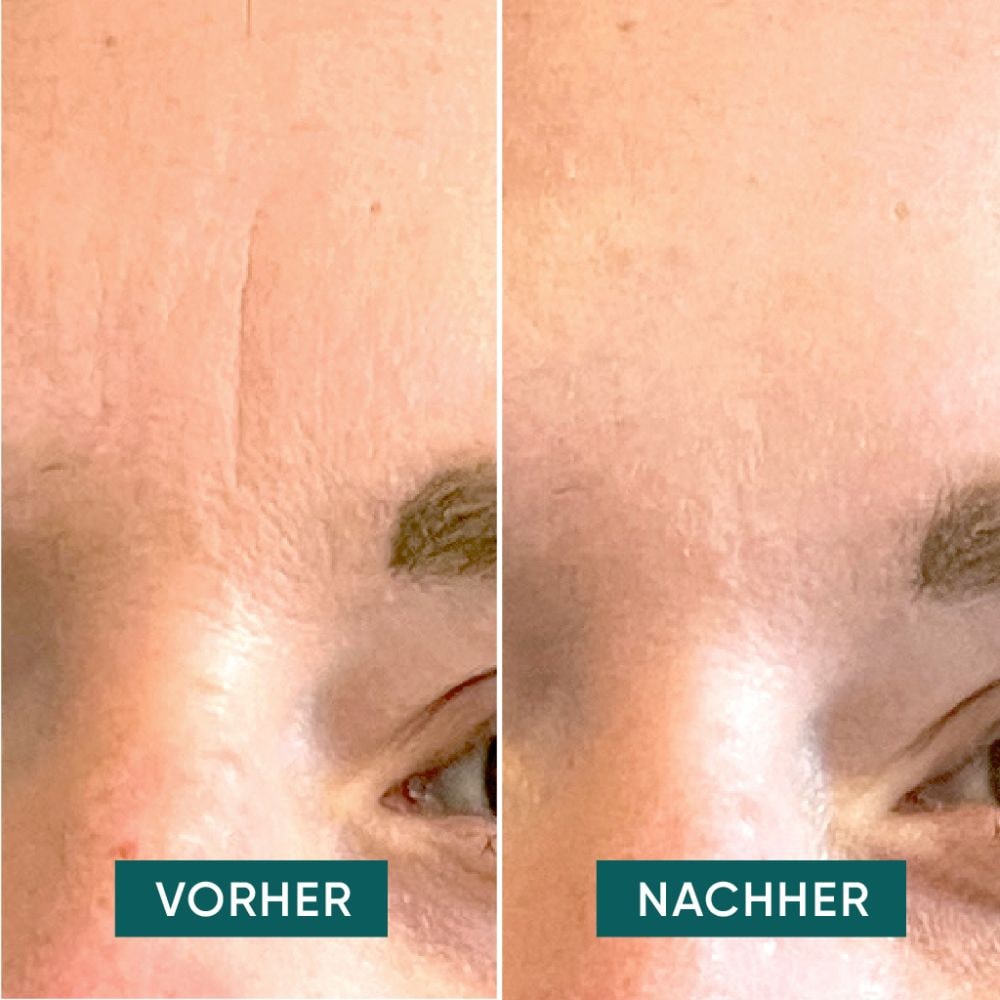 APRICOT Facial Patches down the frown 100 St Pflaster APRICOT Facial Patches down the frown 100 St Pflaster