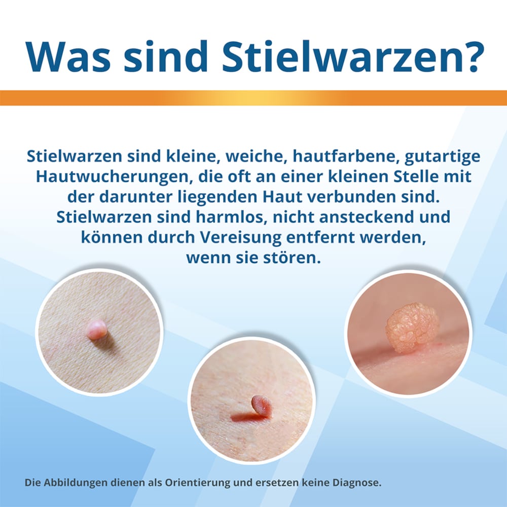 EndWarts Extra gegen Stielwarzen 14.3 g Spray