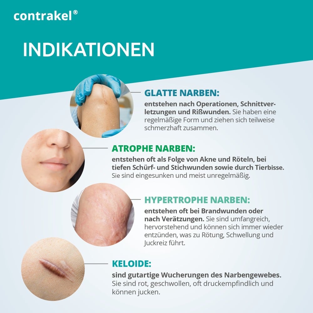 Contrakel Narbencreme mit Kelosun Sonnenschutz 30 ml Creme